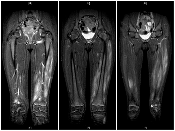 Figura 2. Pápulas de Gottron en manos y rodillas
