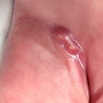 Figura 1. Absceso en región inguinal derecha