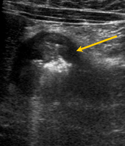 Figura 2. Sección transversal del duodeno. Con la flecha amarilla remarcamos el importante engrosamiento de su pared. La pared del duodeno se ve de color oscuro. Los tonos blancos de su interior corresponden al contenido intestinal