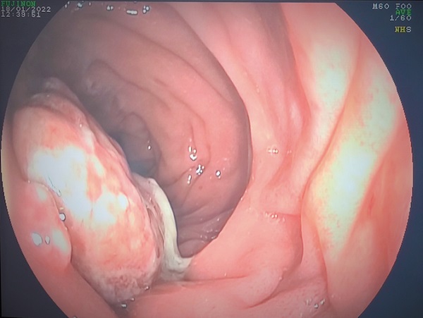 Figura 1. Lesión polipoidea cubierta por fibrina y mucosidad.