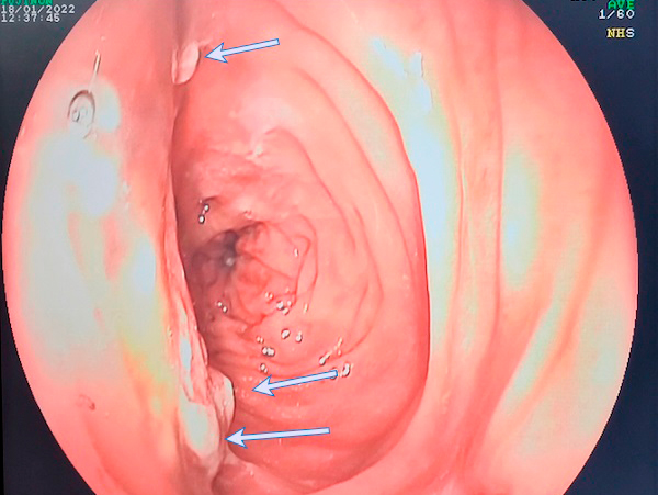 Figura 2. Lesiones satélites.