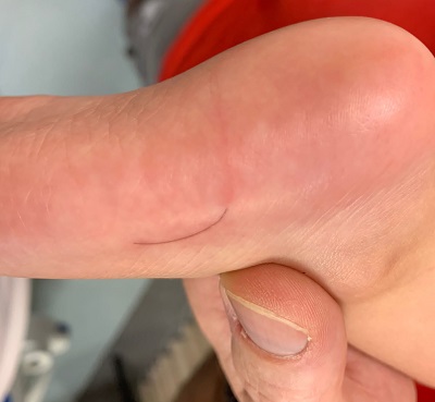 Figura 1. Lesión con trayecto lineal, eritematoso y extremo de tonalidad oscura