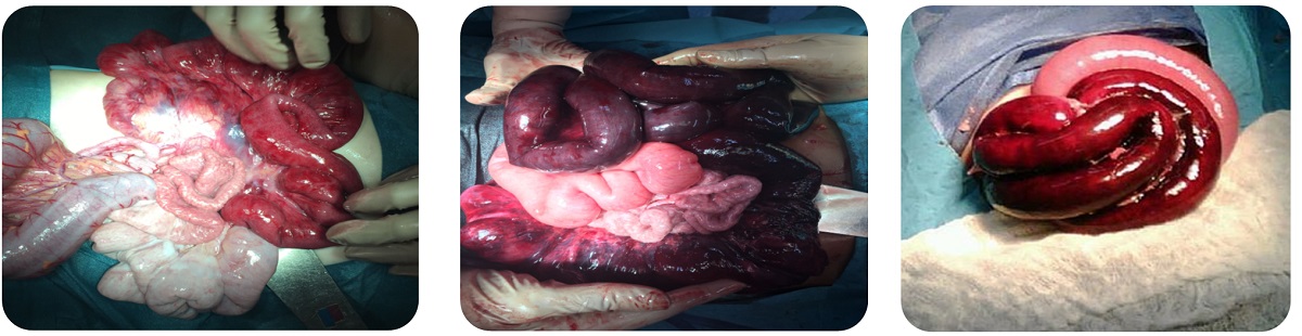 Figura 2. Imágenes intraoperatorias de pacientes. En todos se realizó tratamiento quirúrgico urgente, siendo necesaria la devolvulación en tres de ellos, mientras que uno se había devolvulado espontáneamente objetivando signos de hipoperfusión intestinal en resolución