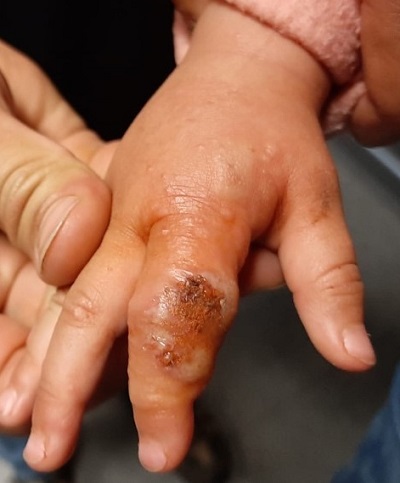 Figura 1. Panadizo herpético en segundo dedo de mano izquierda.