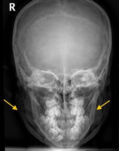 Figura 1. Signos de neumoparótida bilateral con extensión del enfisema subcutáneo a región laterocervical bilateral.