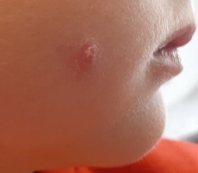 Figura 1. Granuloma aséptico facial idiopático