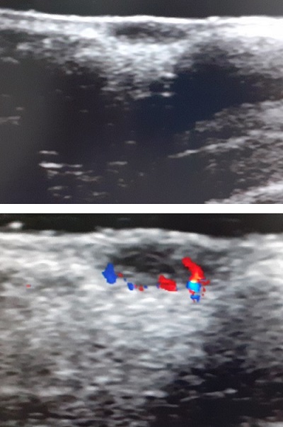 Figura 2. Imágenes ecográficas: lesión nodular hipoecogénica, sin calcificaciones y con flujo vascular periférico