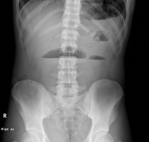 Figura 1. Fibrosis quística y síndrome de obstrucción intestinal distal. Asas de intestino delgado dilatadas en mesogastrio e hipocondrio izquierdo, con formación de niveles hidroaéreos.