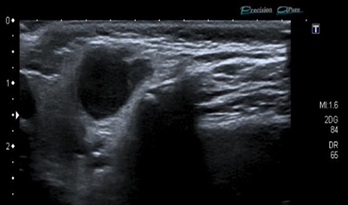 Figura 4. Paciente de 23 meses. Ecografía de nódulo intraparotideo por micobacterias no tuberculosas (M. lentiflavum)