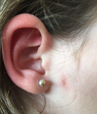 Figura 5. Paciente de 23 meses. Linfadenitis preauricular por micobacterias no tuberculosas. Cicatriz residual