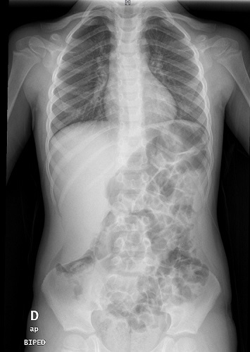 Figura 1. Lóbulo de Riedel hepático como variante anatómica de la normalidad. Resto de estructuras abdominales sin alteraciones significativas. No alteraciones pleuroparenquimatosas significativas. Índice cardiotorácico en el rango de la normalidad