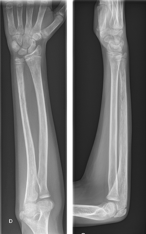 Figura 3. Rx de muñeca y antebrazo derechos al ingreso. Cúbito con patrón óseo permeativo y apolillado con reacción perióstica