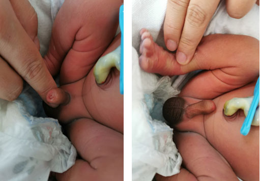 Figura 1. Pene en erección al tercer día de vida, sin signos de sufrimiento isquémico.