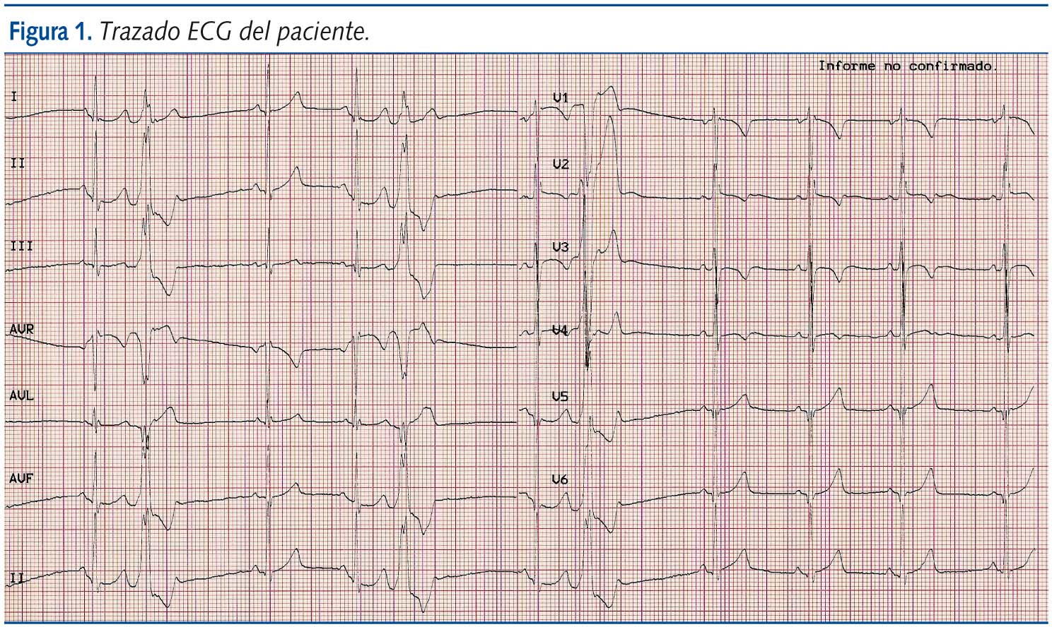Figura 1. Trazado ECG del paciente.