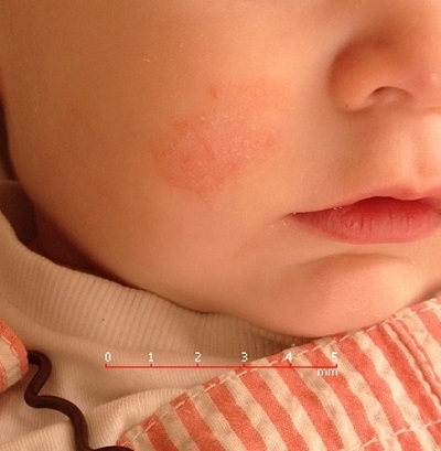 Figura 1. Lesión redondeada, de unos 3 cm, en mejilla derecha. 