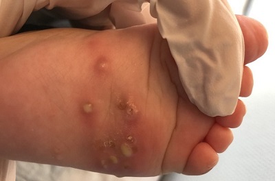 Figura 2. Conjunto de pústulas y lesiones costrosas en planta del pie muy pruriginosas