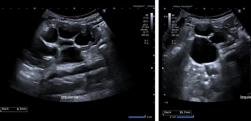 Figura 1. Ecografía de riñón izquierdo. Imagen izda.: marcada disminución de la cortical, grosor máximo de 6,3 mm. Imagen dcha.: diámetro longitudinal de 101,9 mm, gran dilatación pielocalicial con diámetro AP de pelvis de 35,7 mm.