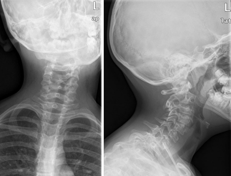 Figura 1. Radiografía simple en la que se aprecia alteración en la alineación de apófisis espinosas y dudosa asimetría de masas laterales del atlas