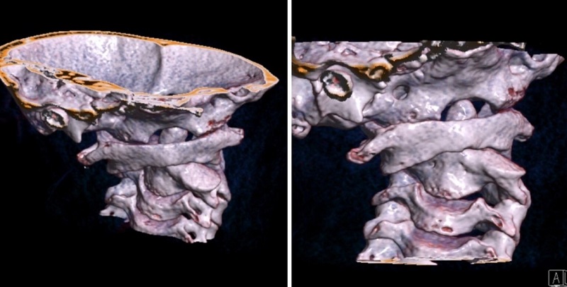 Figura 2. TAC donde se observa desplazamiento de masas laterales de C1 y C2 en relación con subluxación atloaxoidea