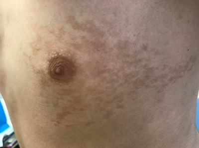 Figura 1. Nevus de Becker en zona anterior derecha del tórax