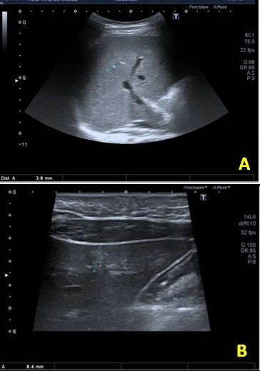 Figura 1. (A). Hemangioma 3,8 mm. (B). Hemangioma 8,4 mm lóbulo izquierdo.