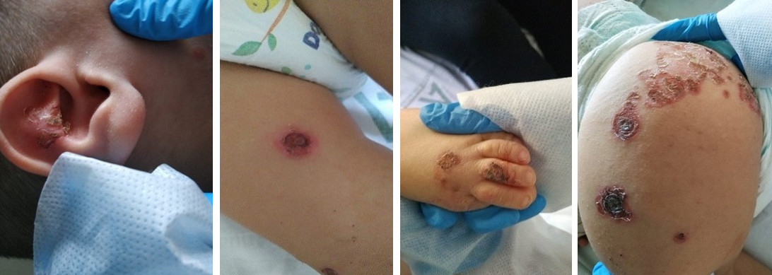 Figura 1.  Lesiones costrosas.