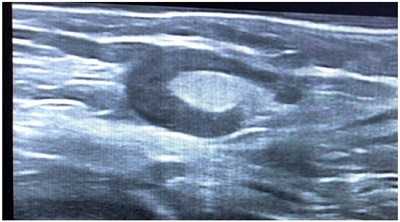 Figura 1. Adenopatía hipoecoica.