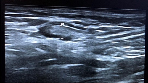 Figura 3. Adenopatía reactivas