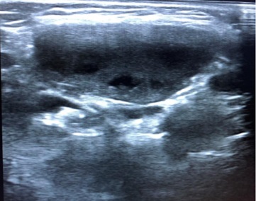 Figura 4. Adenopatía heterogénea con focos hipoecoicos