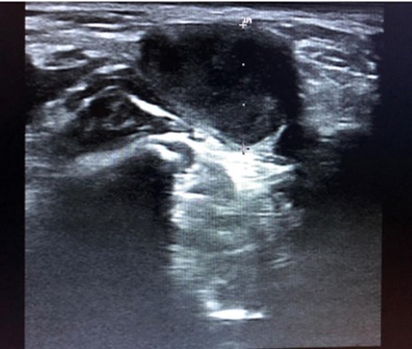 Figura 6. Adenopatía redonda, heterogénea