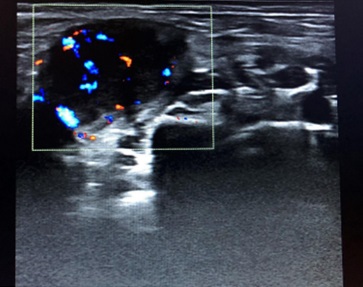 Figura 7. Adenopatía redonda, heterogénea, con una vascularización periférica