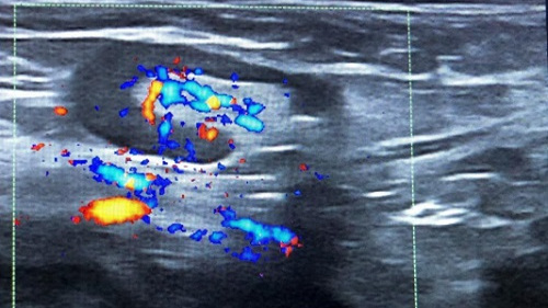 Figura 2. Adenopatía hipoecoica con vascularización central