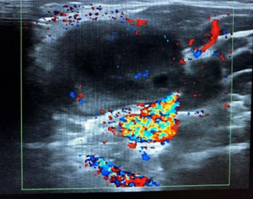 Figura 5. Adenopatía heterogénea con focos hipoecoicos, sin visualizar imagen Doppler central, con artefactos en zonas periféricas
