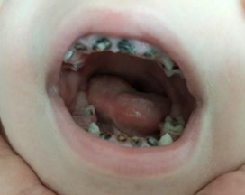 Figura 1. Caries con destrucción masiva de múltiples piezas dentarias temporales