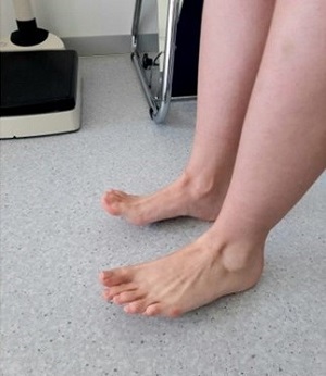 Figura 2. Recuperación a los dos meses.