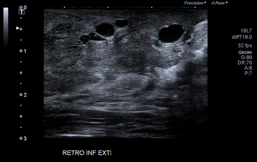 Figura 1. Ecografía de mama: pequeños quistes localizados en la región retroareolar del cuadrante inferoexterno de la mama derecha, el mayor de 6,3 mm de diámetro transverso. 