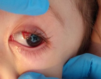 Figura 1. Granuloma piógeno ocular.