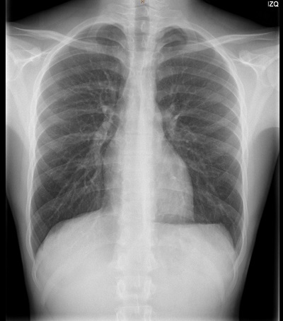 Figura 1. Radiografía de tórax anteroposterior. Neumotórax izquierdo de localización apical con un grosor máximo de 2 cm.