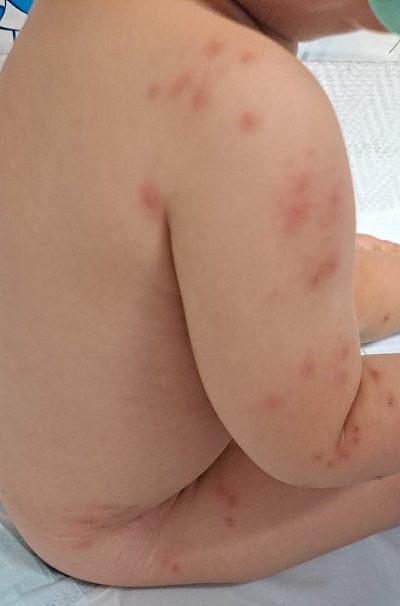 Figura 1. Lesiones papuloeritematosas.