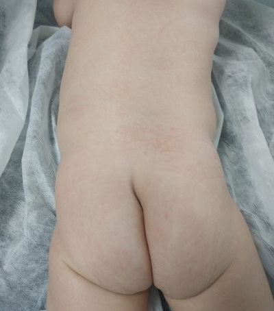 Figura 2. Curva de la hendidura interglútea a nivel sacro hacia la izquierda.