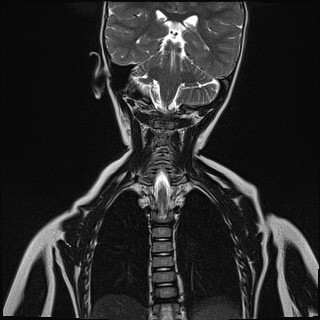 Figura 1. RNM donde se aprecia líquido rodeando masas laterales del atlas, en articulaciones atloaxoideas y aumento de partes blandas rodeando odontoides y entre arco anterior de C1 y membrana tectorial, que tras introducción de contraste intravenoso muestra captación, indicativo de sinovitis activa atlantoaxoidea.