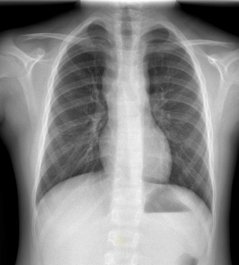 Figura 1. Ensanchamiento mediastínico bilateral.