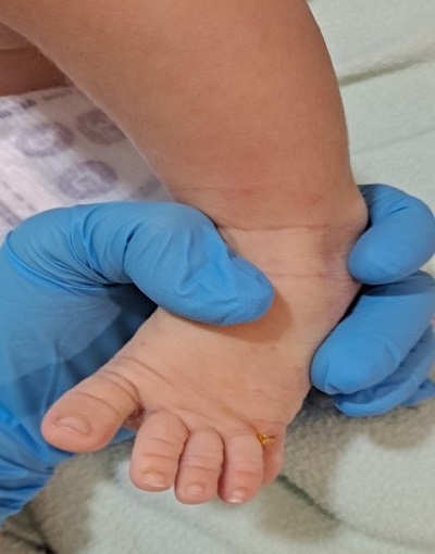 Figura 1. Lesión ampollosa en el pie