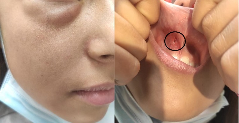 Aumento de volumen en hemicara derecha y herida punzante en mucosa yugal superior (círculo negro)