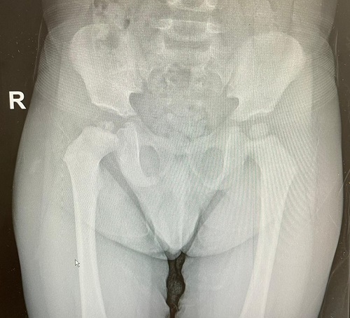 Figura 1. Radiografía anteroposterior de caderas donde se observa fragmentación de la cabeza femoral derecha