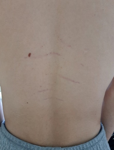 Figura 1. Lesiones lineales horizontales de color rosa perlado