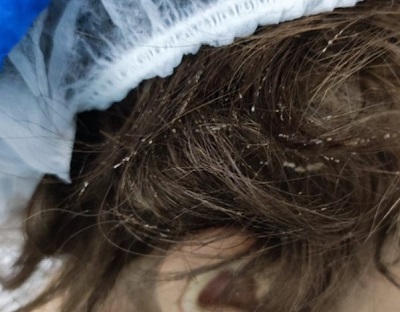 Figura 1. Visualización de múltiples liendres (huevos de Pediculus humanus) en región retroauricular