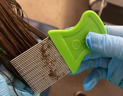 Figura 2. Diagnóstico de visu y tratamiento tópico de pediculosis con peine de púa fina. Se observan múltiples piojos recogidos entre las púas