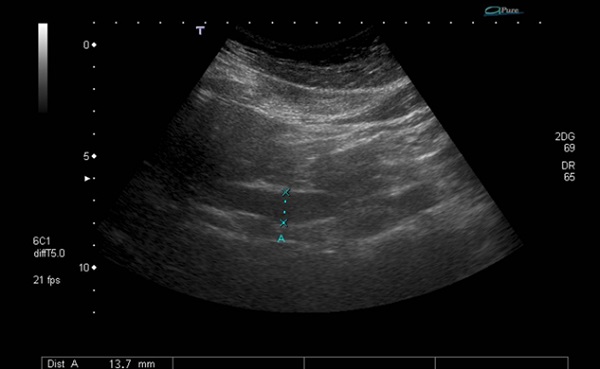 Figura 1. Ecografía abdominal en la que se aprecia dilatación del conducto de 13 mm.