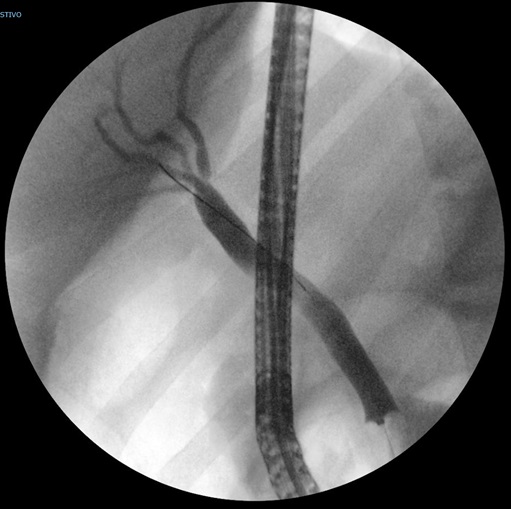 Figura 2. Colangiopancreatografía retrógrada endoscópica (CPRE) en la que se aprecia dilatación de la vía biliar extrahepática, con vía intrahepática normal. No se aprecian defectos de repleción intraluminales. 
